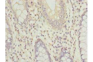 Immunohistochemistry of paraffin-embedded human colon cancer using ABIN7167582 at dilution of 1:100 (RPRD1B anticorps  (AA 2-172))