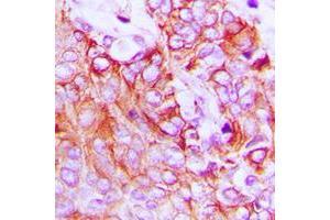 Immunohistochemical analysis of HER4 staining in human breast cancer formalin fixed paraffin embedded tissue section. (ERBB4 anticorps  (C-Term))