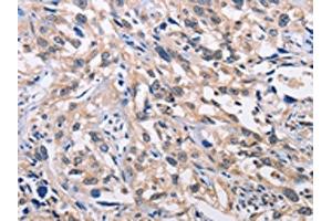 The image on the left is immunohistochemistry of paraffin-embedded Human esophagus cancer tissue using ABIN7128359(ALG8 Antibody) at dilution 1/30, on the right is treated with fusion protein. (ALG8 anticorps)