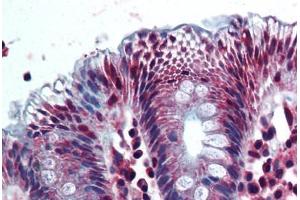 Human Colon (formalin-fixed, paraffin-embedded) stained with AKR1B10 antibody ABIN292629 at 10 ug/ml followed by biotinylated goat anti-rabbit IgG secondary antibody ABIN481713, alkaline phosphatase-streptavidin and chromogen. (AKR1B10 anticorps  (AA 100-200))