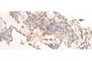 Immunohistochemistry of paraffin-embedded Human ovarian cancer tissue using IBA57 Polyclonal Antibody at dilution of 1:65(x200) (IBA57 anticorps)