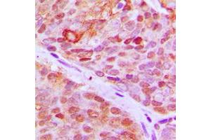Immunohistochemical analysis of ZNF148 staining in human breast cancer formalin fixed paraffin embedded tissue section.
