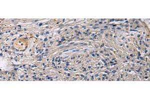 Immunohistochemistry of paraffin-embedded Human brain tissue using SLC30A3 Polyclonal Antibody at dilution of 1:55(x200)
