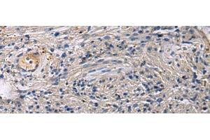 Immunohistochemistry of paraffin-embedded Human brain tissue using SLC30A3 Polyclonal Antibody at dilution of 1:55(x200) (Slc30a3 anticorps)