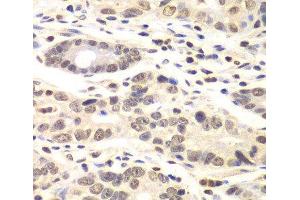 Immunohistochemistry of paraffin-embedded Human colon carcinoma using CCNC Polyclonal Antibody at dilution of 1:100 (40x lens). (Cyclin C anticorps)