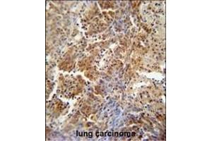 ERCC8 antibody (Center) (ABIN654909 and ABIN2844556) immunohistochemistry analysis in formalin fixed and paraffin embedded human lung carcinoma followed by peroxidase conjugation of the secondary antibody and DAB staining. (ERCC8 anticorps  (AA 210-238))