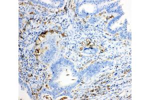 Anti-TRPC6 antibody, IHC(P) IHC(P): Human Intestinal Cancer Tissue