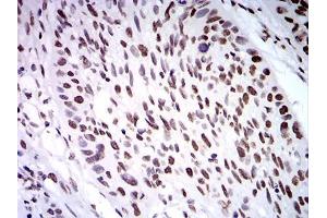 Immunohistochemical analysis of paraffin-embedded esophageal cancer tissues using ZFP91 mouse mAb with DAB staining. (ZFP91 anticorps  (AA 162-304))