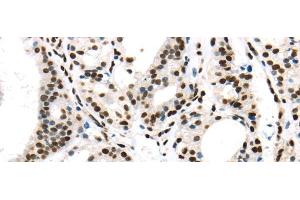 Immunohistochemistry of paraffin-embedded Human thyroid cancer using DDX39B Polyclonal Antibody at dilution of 1/40 (DDX39B anticorps)