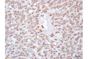 Paraformaldehyde-fixed, paraffin embedded human liver carcinoma tissue, Antigen retrieval by boiling in sodium citrate buffer(pH6) for 15min, Block endogenous peroxidase by 3% hydrogen peroxide for 30 minutes, Blocking buffer (normal goat serum) at 37°C for 20min, Antibody incubation with Rabbit Anti-MFSD2A Polyclonal Antibody, Unconjugated  at 1:200 overnight at 4°C, followed by a conjugated secondary and DAB staining