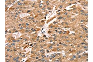 The image on the left is immunohistochemistry of paraffin-embedded Human liver cancer tissue using ABIN7192291(SDC3 Antibody) at dilution 1/30, on the right is treated with synthetic peptide. (SDC3 anticorps)