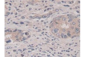 IHC-P analysis of Human Prostate cancer Tissue, with DAB staining.