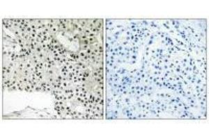 Immunohistochemistry analysis of paraffin-embedded human breast carcinoma tissue using TCEAL4 antibody. (TCEAL4 anticorps)