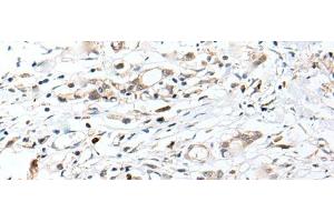 Immunohistochemistry of paraffin-embedded Human gastric cancer tissue using CHRNA5 Polyclonal Antibody at dilution of 1:50(x200) (CHRNA5 anticorps)