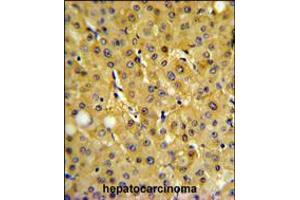 FBP1 Antibody IHC analysis in formalin fixed and paraffin embedded human hepatocarcinoma followed by peroxidase conjugation of the secondary antibody and DAB staining. (FBP1 anticorps  (AA 125-156))