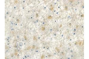 ABIN7094012 and ABIN7098056 at 1/100 staining human astrocytoma by IHC-P. (TALDO1 anticorps  (N-Term))