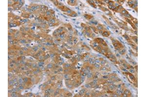 The image on the left is immunohistochemistry of paraffin-embedded Human liver cancer tissue using ABIN7192256(SAMD4A Antibody) at dilution 1/30, on the right is treated with synthetic peptide. (SAMD4A anticorps)