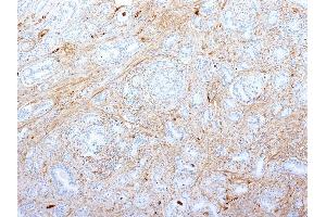 Formalin-fixed, paraffin-embedded human Pancreatic Adenocarcinoma stained with Fibronectin Monoclonal Antibody (SPM539). (Fibronectin 1 anticorps)