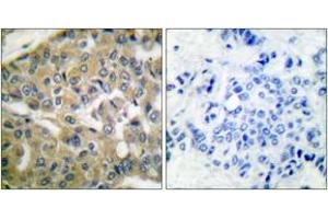 Immunohistochemistry analysis of paraffin-embedded human breast carcinoma tissue, using FHIT Antibody.