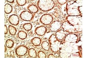 Immunohistochemical analysis of paraffin-embedded Human Colon Carcinoma Tissue using Acetyl P53(K382) Mouse mAb diluted at 1:2000