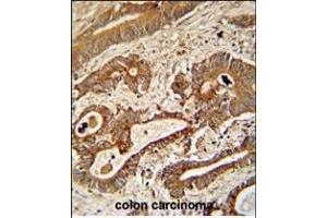 ETHE1 Antibody (Center) (ABIN390581 and ABIN2840904) immunohistochemistry analysis in formalin fixed and paraffin embedded human colon carcinoma followed by peroxidase conjugation of the secondary antibody and DAB staining.