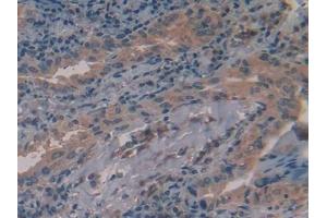 Detection of ALT in Human Thyroid cancer Tissue using Polyclonal Antibody to Alanine Aminotransferase (ALT)