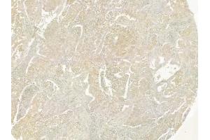 ABIN6259331 and ABIN6275349 at 1/100 staining human lung squamous cell carcinoma by IHC-P.