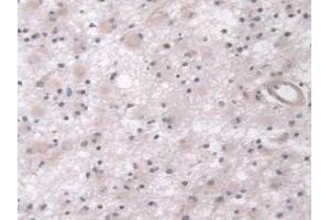 IHC-P analysis of Human Glioma Tissue, with DAB staining. (AHNAK anticorps  (AA 1-300))