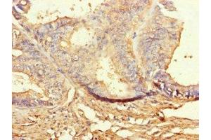 Immunohistochemistry of paraffin-embedded human endometrial cancer using ABIN7160080 at dilution of 1:100 (BUB1B anticorps  (AA 230-394))