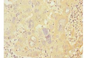 Immunohistochemistry of paraffin-embedded human liver cancer using ABIN7146619 at dilution of 1:100