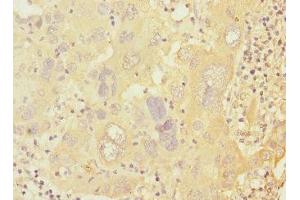Immunohistochemistry of paraffin-embedded human liver cancer using ABIN7146619 at dilution of 1:100 (PRKAR1B anticorps  (Regulatory Subunit))