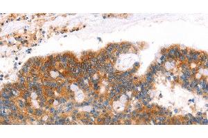 Immunohistochemistry of paraffin-embedded Human colon cancer tissue using AFDN Polyclonal Antibody at dilution 1:40 (Afadin anticorps)