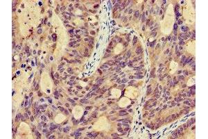 Immunohistochemistry of paraffin-embedded human colon cancer using ABIN7146326 at dilution of 1:100 (EFHA1 anticorps  (AA 26-247))