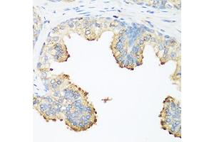 Immunohistochemistry of paraffin-embedded human prostate using PLEK antibody (ABIN6290796) at dilution of 1:200 (40x lens). (Pleckstrin anticorps)
