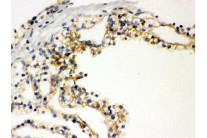 Anti- SLC12A1 Picoband antibody, IHC(P) IHC(P): Human Kidney Cancer Tissue (SLC12A1 anticorps  (N-Term))