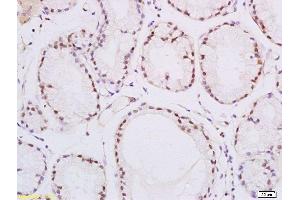 Formalin-fixed and paraffin embedded human esophageal carcinoma labeled with Rabbit Anti-PPAR delta Polyclonal Antibody, Unconjugated  at 1:200 followed by conjugation to the secondary antibody and DAB staining