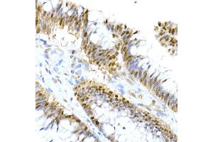 Immunohistochemistry of paraffin-embedded human colon carcinoma using HNF-4-alpha Rabbit mAb (ABIN7267621) at dilution of 1:150 (40x lens). (HNF4A anticorps)