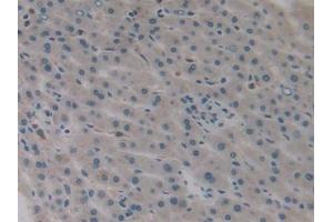 Detection of IL1a in Human Liver cancer Tissue using Monoclonal Antibody to Interleukin 1 Alpha (IL1a)