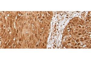 Immunohistochemistry of paraffin-embedded Human lung cancer tissue using UBA7 Polyclonal Antibody at dilution of 1:35(x200) (UBA7 anticorps)