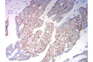 Immunohistochemical analysis of paraffin-embedded ovarian cancer tissues using KRT18 mouse mAb with DAB staining.