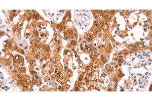 Immunohistochemistry of paraffin-embedded Human lung cancer using NCEH1 Polyclonal Antibody at dilution of 1:80 (NCEH1 anticorps)