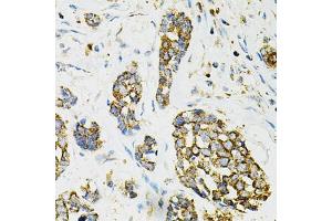 Immunohistochemistry of paraffin-embedded human esophageal cancer using ADSS antibody. (ADSS anticorps)