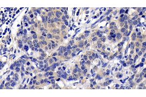 Detection of CASP8 in Human Lymphoma Tissue using Polyclonal Antibody to Caspase 8 (CASP8)