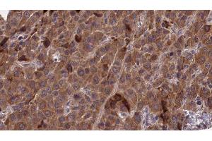 ABIN6277268 at 1/100 staining Human liver cancer tissue by IHC-P. (PAK1 anticorps  (N-Term))
