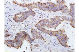 Paraformaldehyde-fixed, paraffin embedded Human colon cancer Antigen retrieval by boiling in sodium citrate buffer (pH6.