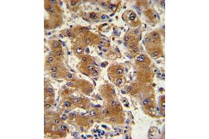 Formalin-fixed and paraffin-embedded human hepatocarcinoma with COL6A1 Antibody (C-term), which was peroxidase-conjugated to the secondary antibody, followed by DAB staining.