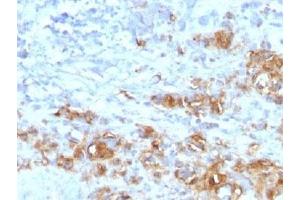 IHC testing of FFPE human gastric carcinoma with recombinant CA19-9 antibody (CA19. (Recombinant CA 19-9 anticorps)