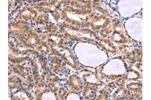 The image on the left is immunohistochemistry of paraffin-embedded Human thyroid cancer tissue using ABIN7129127(CYP1B1 Antibody) at dilution 1/20, on the right is treated with fusion protein.