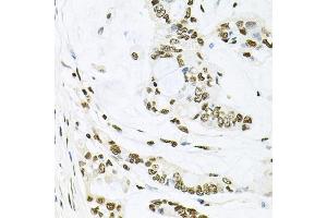 Immunohistochemistry of paraffin-embedded human gastric cancer using MAPK8 antibody (ABIN5970116) at dilution of 1/100 (40x lens). (JNK anticorps)