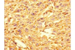 Immunohistochemistry of paraffin-embedded human melanoma using ABIN7154300 at dilution of 1:100 (GOLPH3L anticorps  (AA 6-285))